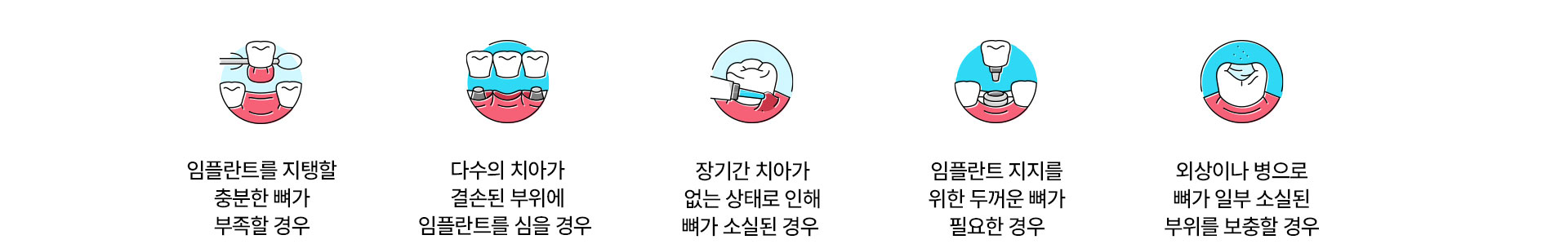 임플란트 지지를 위한 두꺼운 뼈가 필요한 경우