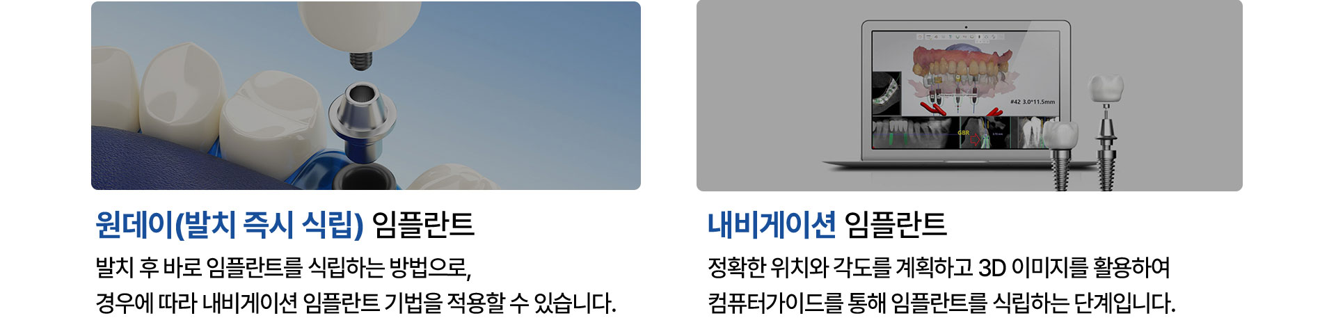 원데이 임플란트, 내비게이션 임플란트