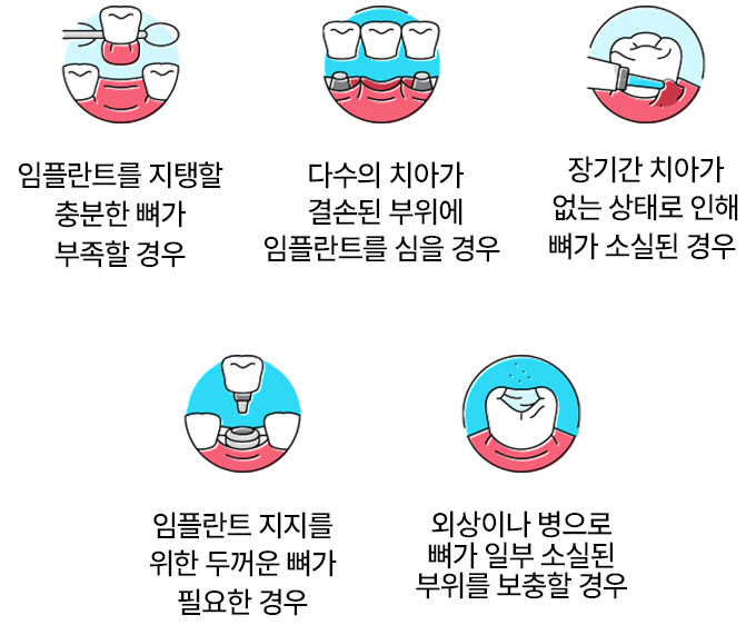임플란트를 지탱할 충분한 뼈가 부족할 경우, 다수의 치아가 결손된 부위에 임플란트를 심을 경우, 장기간 치아가 없는 상태로 인해 뼈가 소실된 경우, 임플란트 지지를 위한 두꺼운 뼈가 필요한 경우, 외상이나 병으로 뼈가 일부 소실된 부위를 보충할 경우