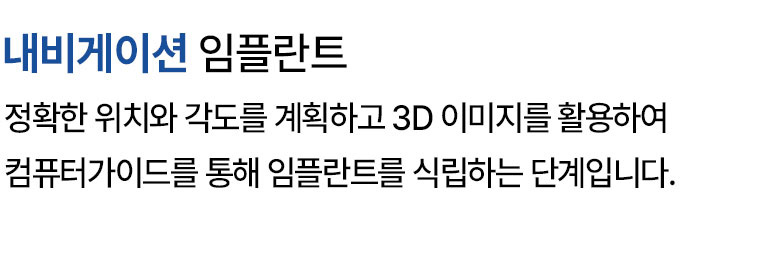 내비게이션 임플란트